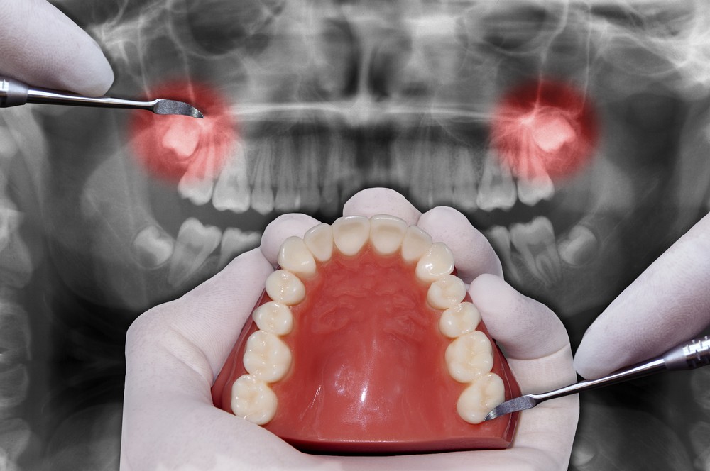 A person smiling with dental implants